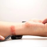 Nguyên Nhân Gây Dị Ứng Khi Đeo Đồng Hồ Thể Thao: Cảnh Báo Về Sức Khỏe Da